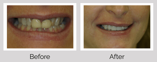 Crowns & Bridges Before and After - Crown Point Dental