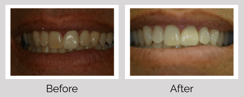 Crowns & Bridges Before and After - Crown Point Dental