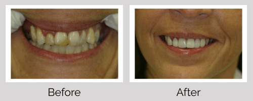 Crowns & Bridges Before and After - Crown Point Dental