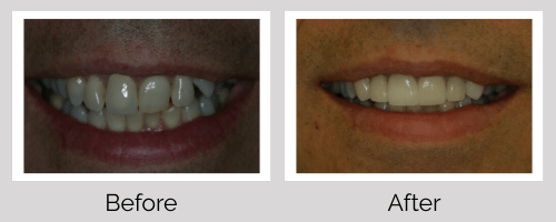 Crowns & Bridges Before and After - Crown Point Dental