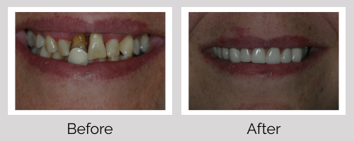 Crowns & Bridges Before and After - Crown Point Dental