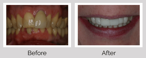 Crowns & Bridges Before and After - Crown Point Dental