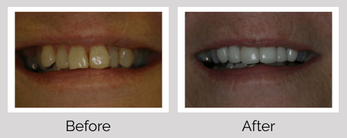 Crowns & Bridges Before and After - Crown Point Dental