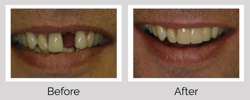 Crowns & Bridges Before and After - Crown Point Dental