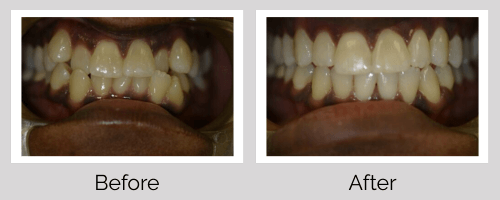 Invisalign/Orthodontics Before and After - Crown Point Dental