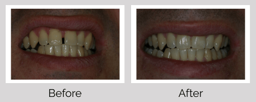 Invisalign/Orthodontics Before and After - Crown Point Dental