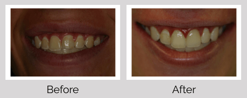 Invisalign/Orthodontics Before and After - Crown Point Dental