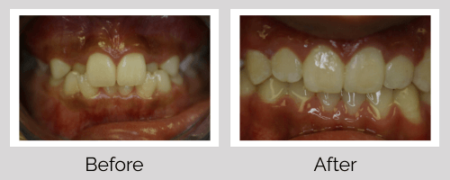 Invisalign/Orthodontics Before and After - Crown Point Dental