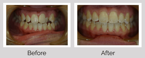 Invisalign/Orthodontics Before and After - Crown Point Dental