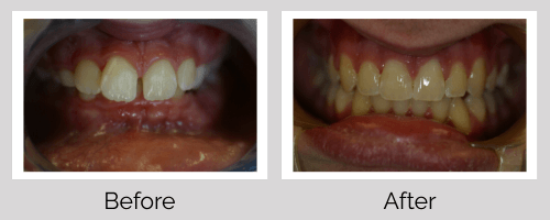 Invisalign/Orthodontics Before and After - Crown Point Dental