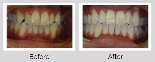 Invisalign/Orthodontics Before and After - Crown Point Dental