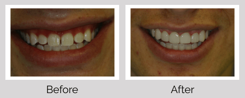 Veneers Before and After - Crown Point Dental