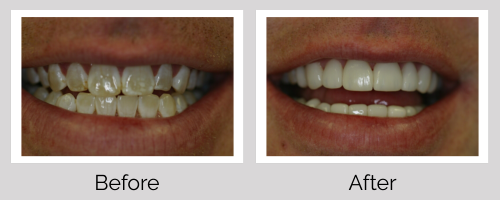 Veneers Before and After - Crown Point Dental