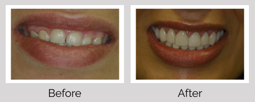 Veneers Before and After - Crown Point Dental