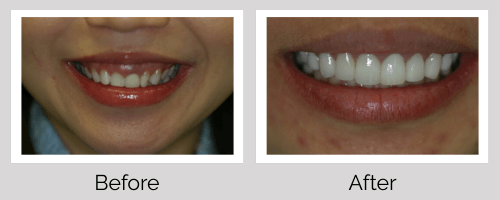 Veneers Before and After - Crown Point Dental