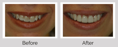 Veneers Before and After - Crown Point Dental