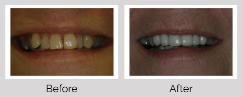 Veneers Before and After - Crown Point Dental