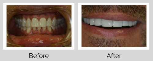 Veneers Before and After - Crown Point Dental