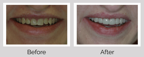 Veneers Before and After - Crown Point Dental