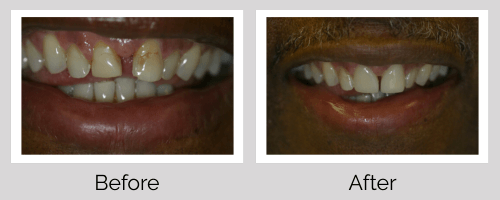 Veneers Before and After - Crown Point Dental