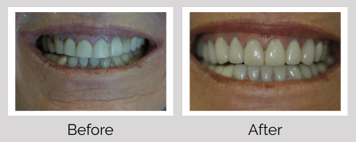 Veneers Before and After - Crown Point Dental