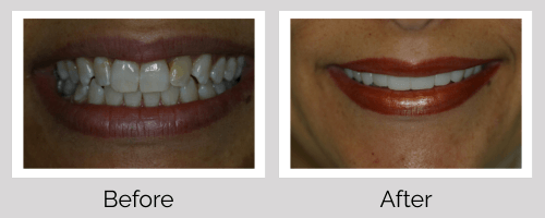 Veneers Before and After - Crown Point Dental