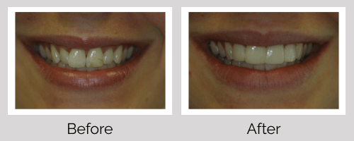 Veneers Before and After - Crown Point Dental