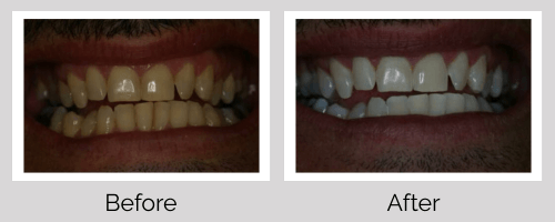 Whitening Before and After - Crown Point Dental