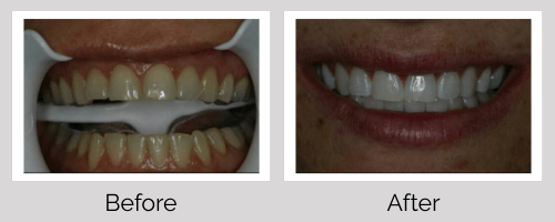 Whitening Before and After - Crown Point Dental