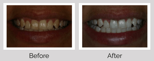 Whitening Before and After - Crown Point Dental
