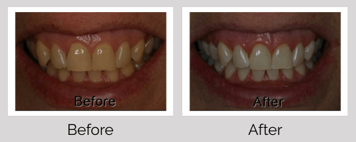 Whitening Before and After - Crown Point Dental