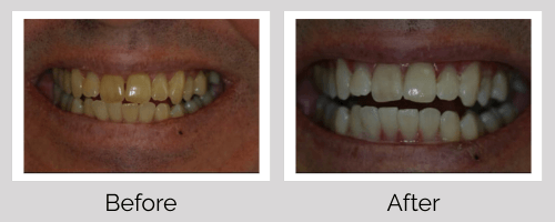 Whitening Before and After - Crown Point Dental