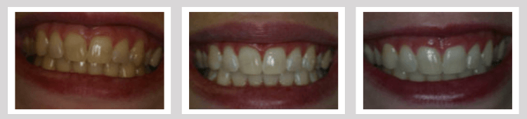 Whitening Before and After - Crown Point Dental