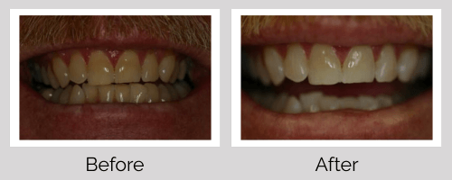 Whitening Before and After - Crown Point Dental