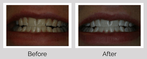 Whitening Before and After - Crown Point Dental