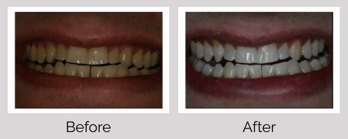 Whitening Before and After - Crown Point Dental