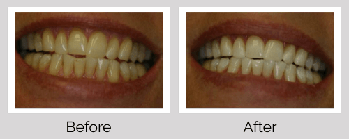 Whitening Before and After - Crown Point Dental