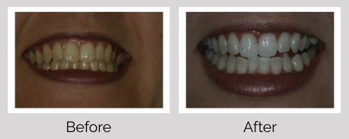 Whitening Before and After - Crown Point Dental