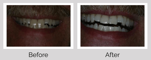 Whitening Before and After - Crown Point Dental
