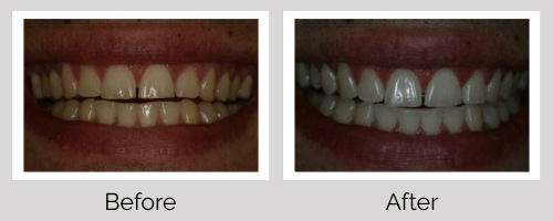 Whitening Before and After - Crown Point Dental