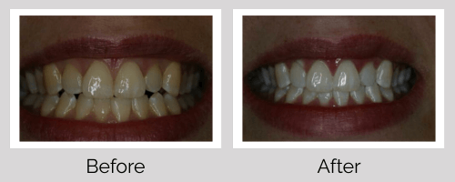 Whitening Before and After - Crown Point Dental