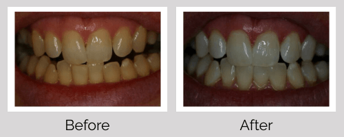 Whitening Before and After - Crown Point Dental