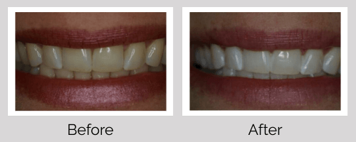 Whitening Before and After - Crown Point Dental