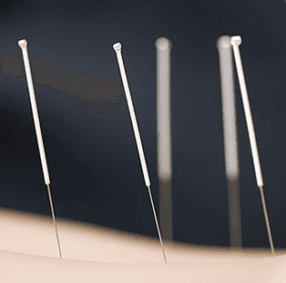 Acupuncture for Back Pain Massapequa, NY
