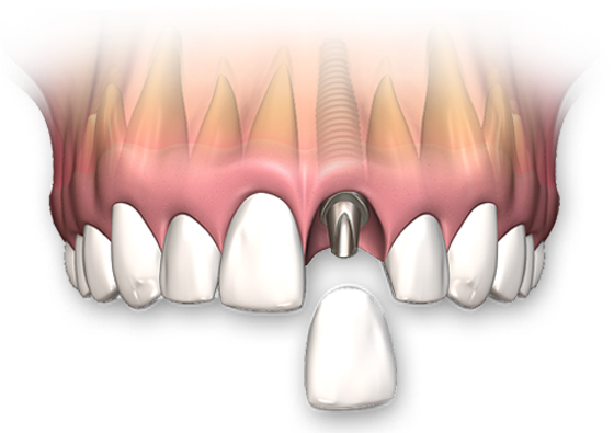 Replace Missing Teeth - Periodontists in Red Deer County