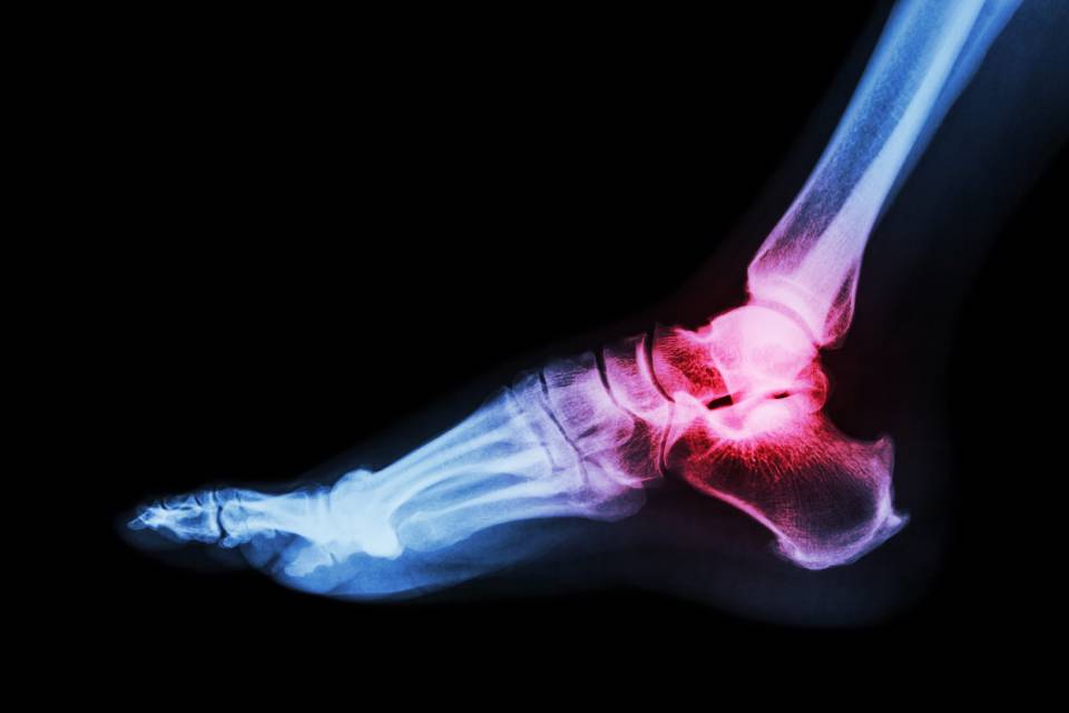 Radiografia del piede e della caviglia, evidenziati in rosso per indicare l'infiammazione, su sfondo nero.