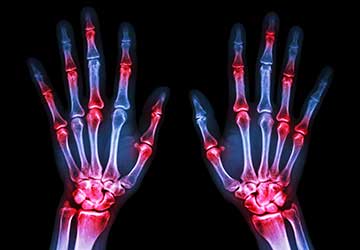 A diagram used by an arthritis doctor in Johnson City, TN A diagram used by an arthritis doctor in Johnson City, TN