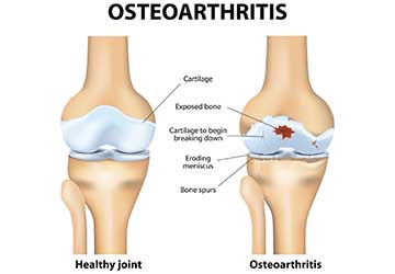 A diagram used by an arthritis doctor in Johnson City, TN A diagram used by an arthritis doctor in Johnson City, TN