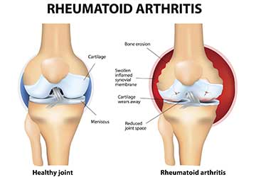 A diagram used by an arthritis doctor in Johnson City, TN A diagram used by an arthritis doctor in Johnson City, TN