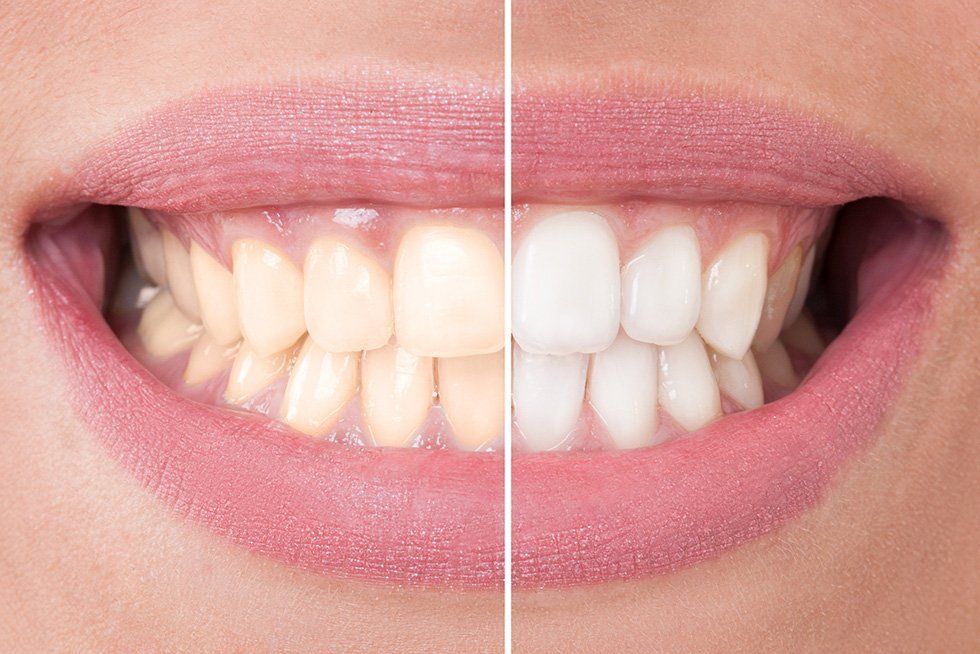 pulizia dei denti